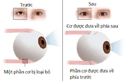 Bệnh mắt lé có cách nào điều trị không?